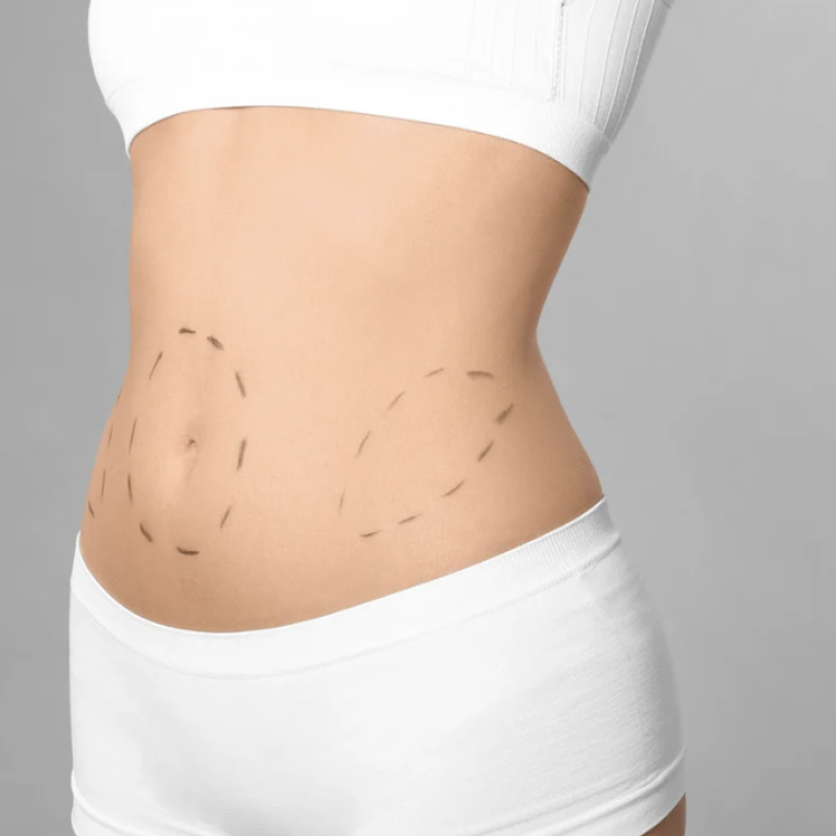 Compare Liposuction Costs in Fairfax VA
